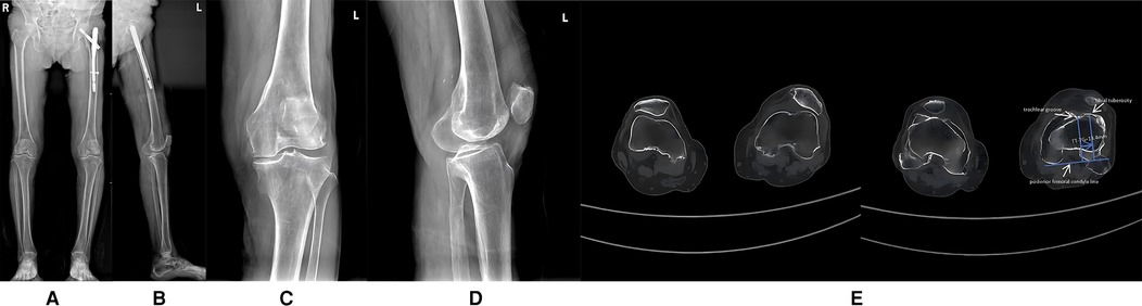 Figure1-Figure4 are preoperative iradiograph: degenerative changes in both knee joint, bilateral genu varum, possible osteochondroma on the medial border of the upper ends of both tibias, suspected patellar dislocation, and the right femur with intramedullary rod fixation. Figure5 revealed left patellar dislocation, is a CT scan series showing axial slices of the knee with anatomical landmarks labeled for alignment assessment.