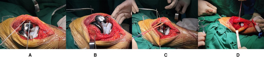 Figure 6-9 displays intraoperative images: The operation process of MPFLr following TKA is shown, along with the fixation position of the graft. Metallic prosthetic components and polyethylene inserts
are in place, surrounded by exposed soft tissue and surgical retractors.