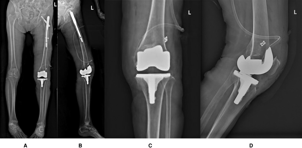 Figure10-13 display four postoperative radiographs to show the position of prosthesis and patella, and the lower limb force line is ideal.