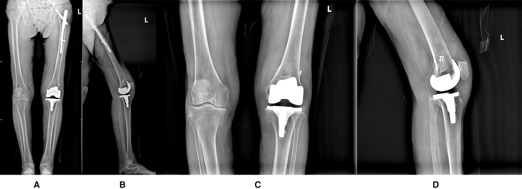 Figure 14-17 presents four radiographs taken at the 7-month postoperative follow-up to shhow the position of prosthesis and patella, and the lower limb force line is ideal.