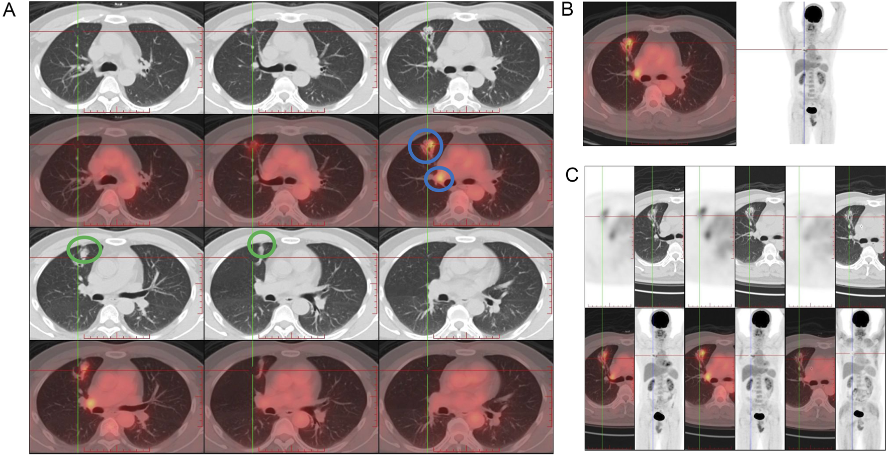 A series of medical imaging scans showing chest cross-sections with highlighted areas. Panel A displays multiple PET-CT scans highlighting lung regions with green and blue circles. Panel B shows a PET-CT scan with a highlighted lung area and a full-body scan. Panel C contains a sequence of PET-CT scans showing varying cross-sections of the chest showing showed a significant reduction in the size of the right upper lobe lesion after two cycles of T-DXd treatment. Bright spots indicate areas of interest, potentially showing abnormal activity or lesions.