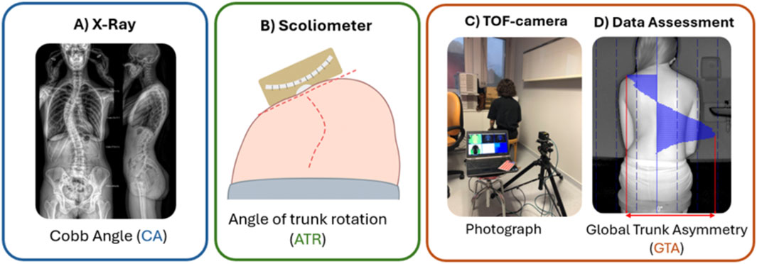 Four-panel image illustrating scoliosis assessment methods. Panel A: X-ray showing Cobb Angle. Panel B: Diagram with a scoliometer measuring the Angle of Trunk Rotation. Panel C: Person seated with a Time-of-Flight camera and laptop, labeled Photograph. Panel D: Image of a back with overlay showing Global Trunk Asymmetry measurement.