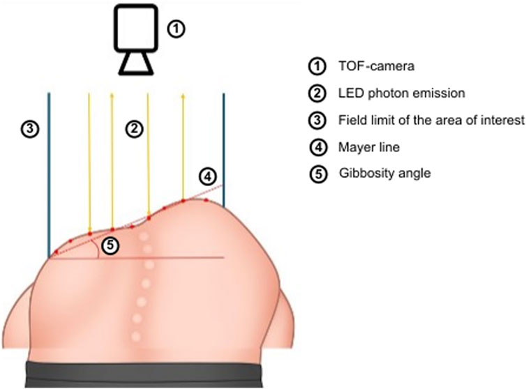 Diagram illustrating a side view of a person's torso with a Time-Of-Flight (TOF) camera labeled as ①, above emitting LED photons marked as ②. The field limit is indicated by line ③. The torso's curvature is outlined with Mayer line ④ and the gibbosity angle is labeled ⑤.