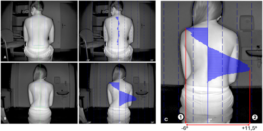Four images show a person from behind, highlighting spinal posture analysis. The top left has a centered rectangle on the back. The top right and bottom right images display spinal curvature with blue contours. The bottom left image also shows the back with a rectangle. The large image on the right includes angles measured at -6 and +11.5 degrees, indicating posture asymmetry.