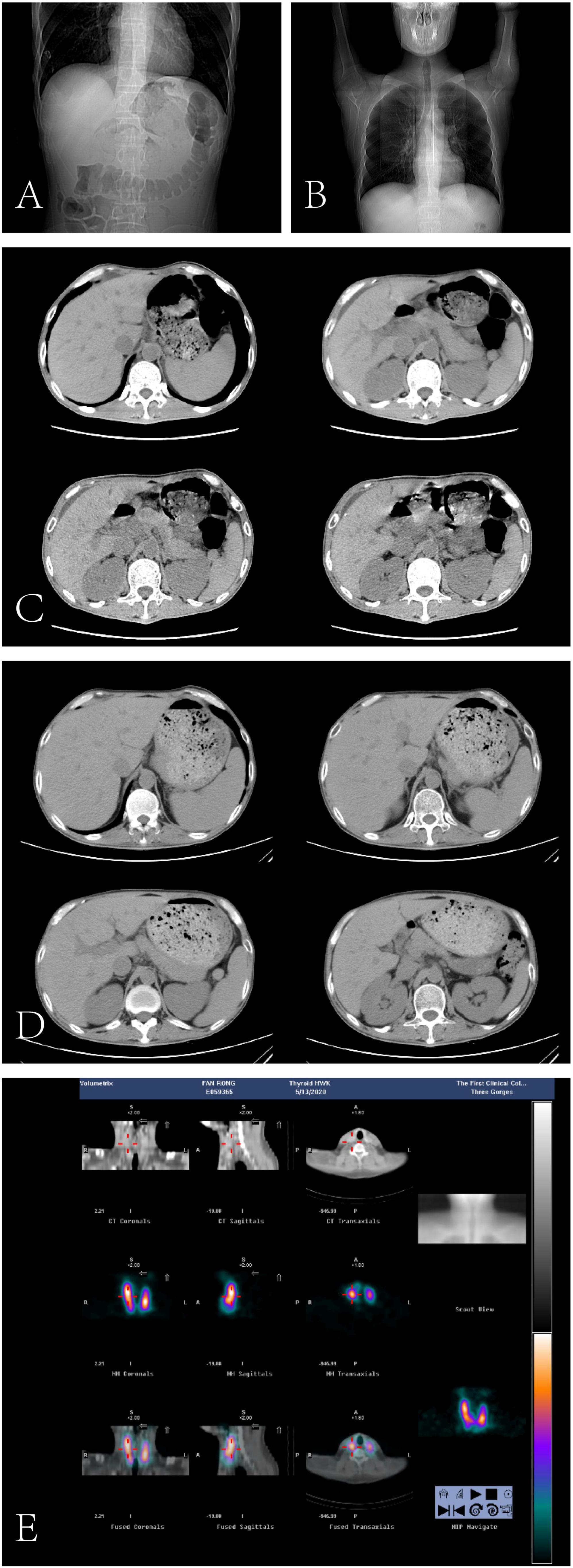 Five panels showing medical imaging results. Panel A: An X-ray image of the abdomen. Panel B: A chest X-ray. Panel C: Four CT scan cross-sections showing various abdominal regions. Panel D: Another set of CT scan cross-sections with different abdominal views. Panel E: Nuclear medicine images with multiple views, including coronal and transverse slices, highlighting areas with different color intensities indicative of varying activity levels.