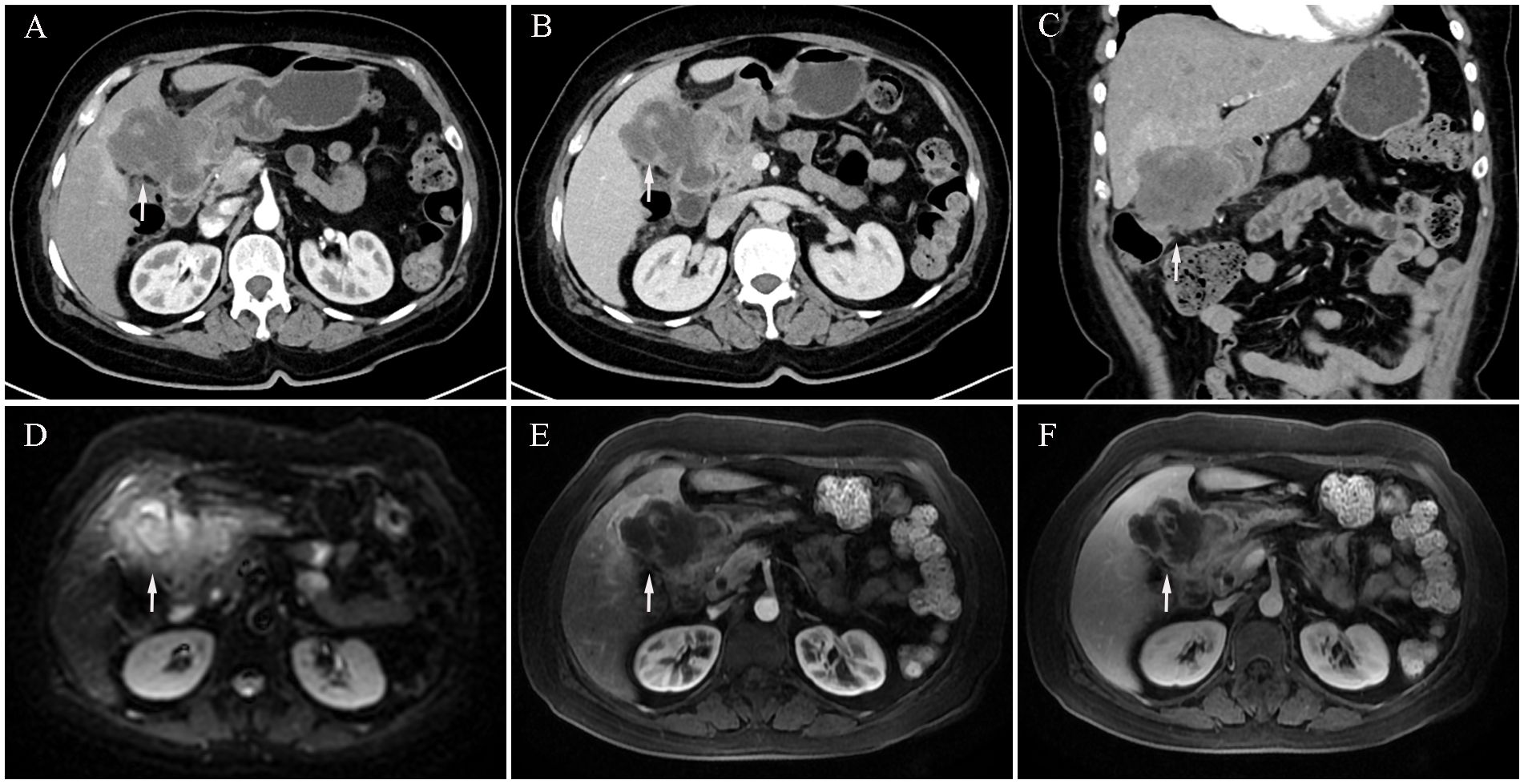 CT and MRI images showing axial and coronal views of the abdominal cavity. Panels A, B, and C are CT images with arrows indicating an area of interest near internal organs. Panels D, E, and F are MRI images, also highlighting a specific region with arrows. The focus is on the differences in tissue contrast and detail between the imaging modalities.