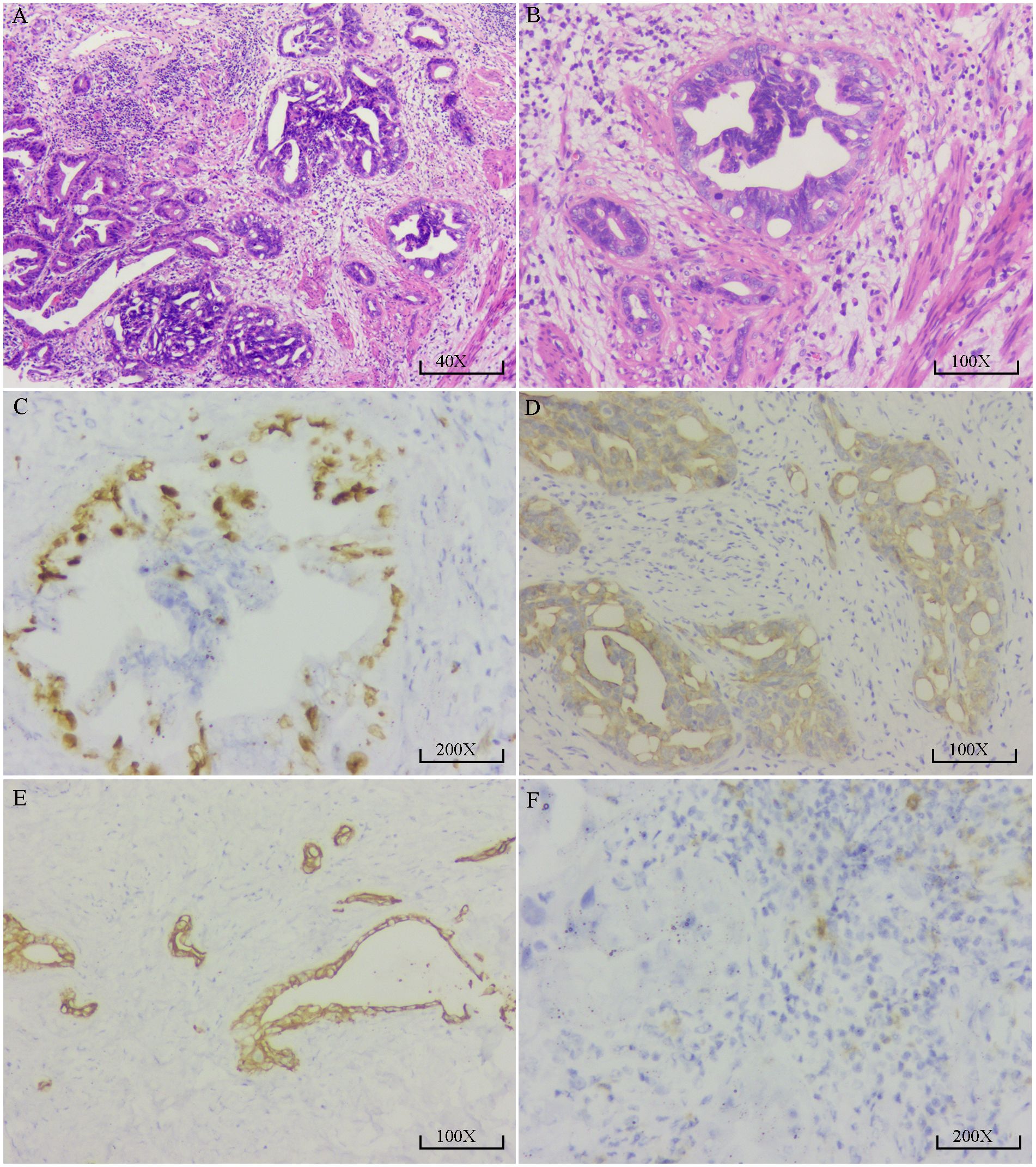 Histological slides show tissue sections at various magnifications. Image A at 40x and B at 100x display glandular structures with purple staining. Image C at 200x and D at 100x highlight brown-stained cells, indicating immunohistochemical staining. Image E at 100x and F at 200x also show cellular staining patterns. Each slide provides microscopic views essential for pathological analysis.