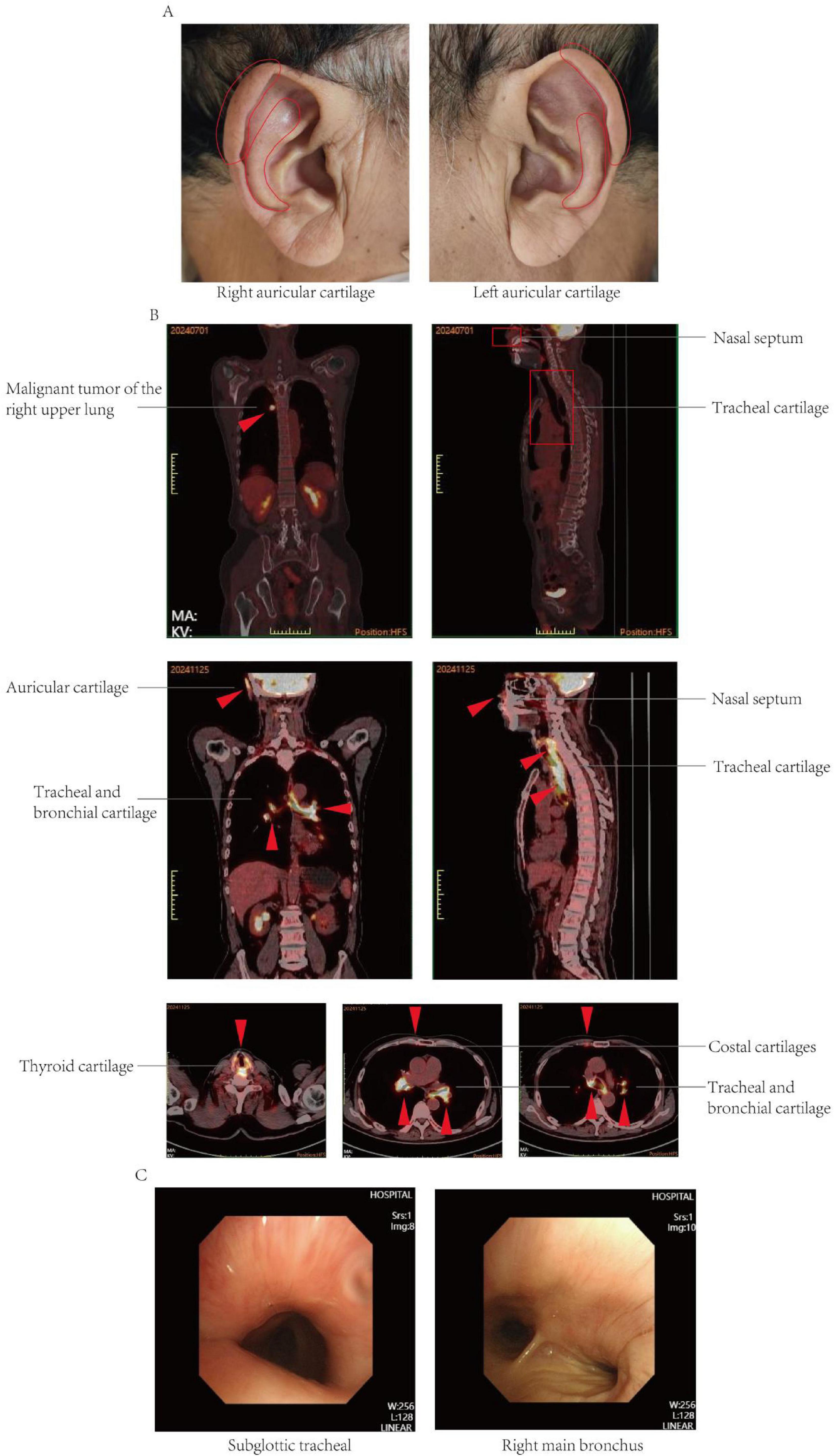 Grouped images show anatomical structures and scan results. Panel A displays right and left auricular cartilage. Panel B contains PET/CT scans highlighting a malignant tumor in the right upper lung and various cartilages, including auricular, tracheal, and bronchial cartilages. Panel C presents endoscopic views of the subglottic trachea and right main bronchus.