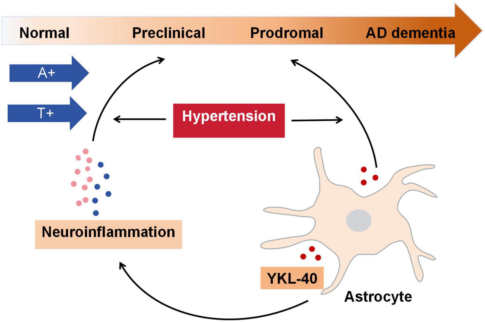 Diagram illustrating the progression from normal to Alzheimer’s dementia. It shows the roles of hypertension, neuroinflammation, and the YKL-40 protein in astrocytes. Arrows indicate progression pathways, with A+ and T+ factors contributing to the process.