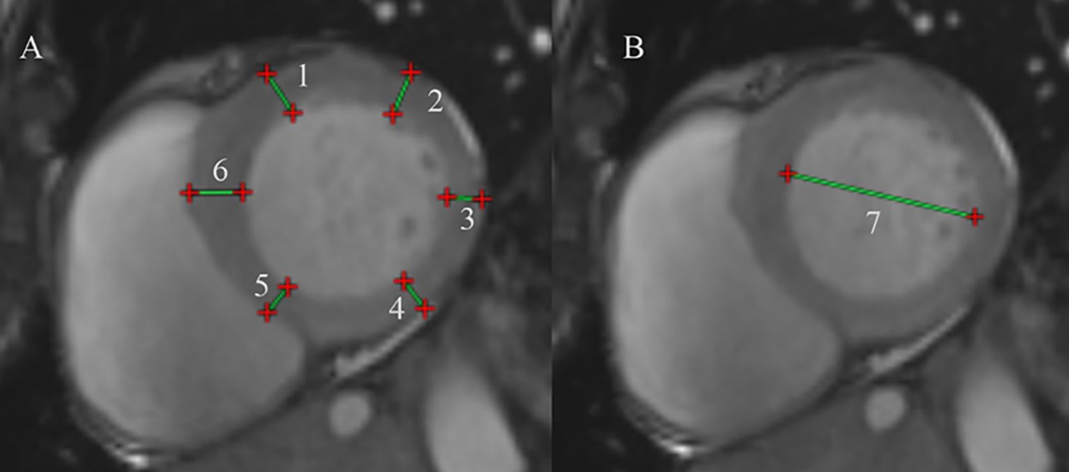 Medical imaging comparison with two panels labeled A and B. Panel A shows a circular structure marked with six red plus signs and connected by green lines numbered one to six. Panel B shows the same structure with a single green line labeled seven extending across it.