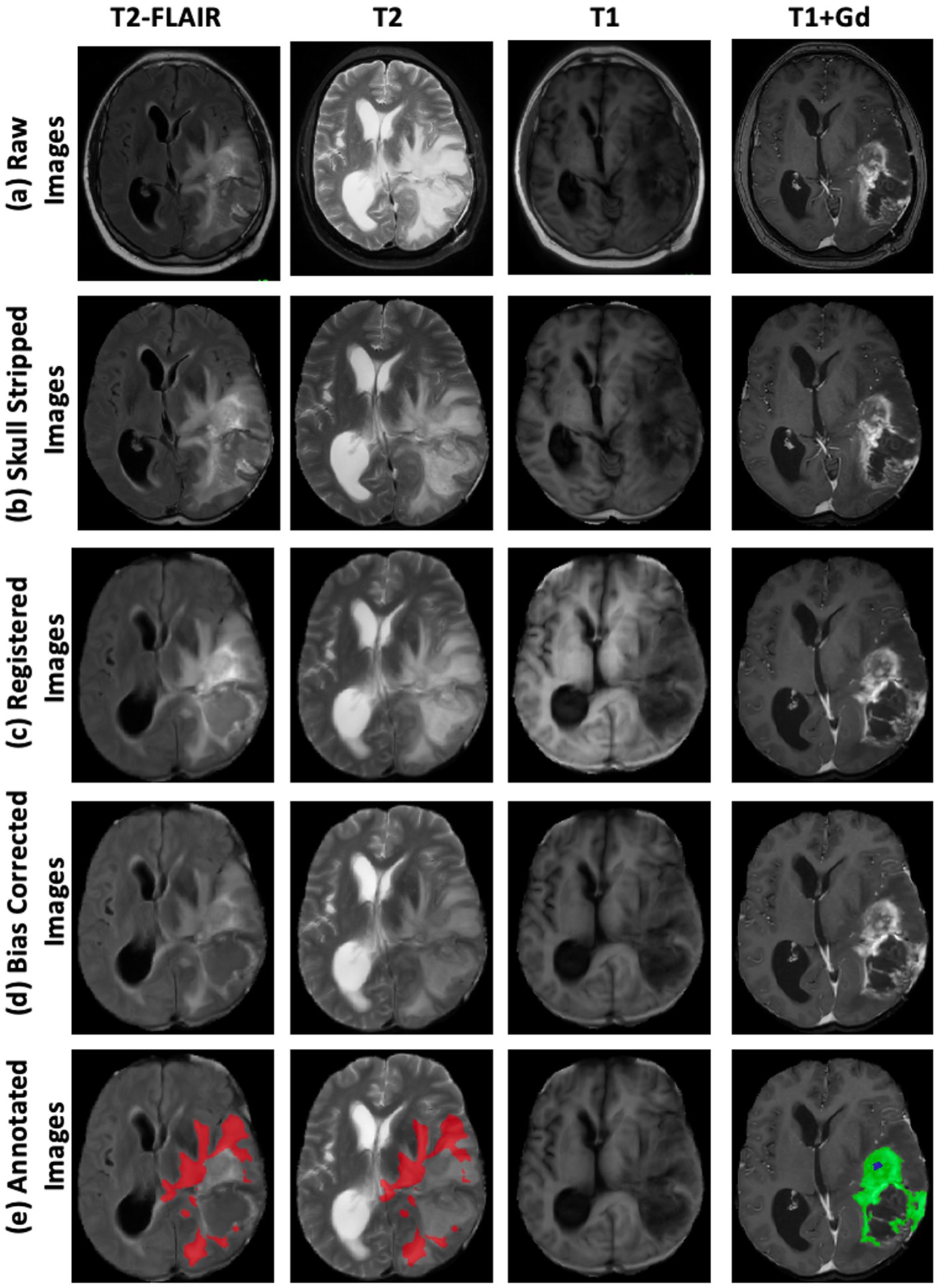 MRI images of a brain in five stages: raw, skull stripped, registered, bias corrected, and annotated. Each stage shows four types: T2-FLAIR, T2, T1, and T1+Gd. Annotations highlight regions in red, green, and blue.