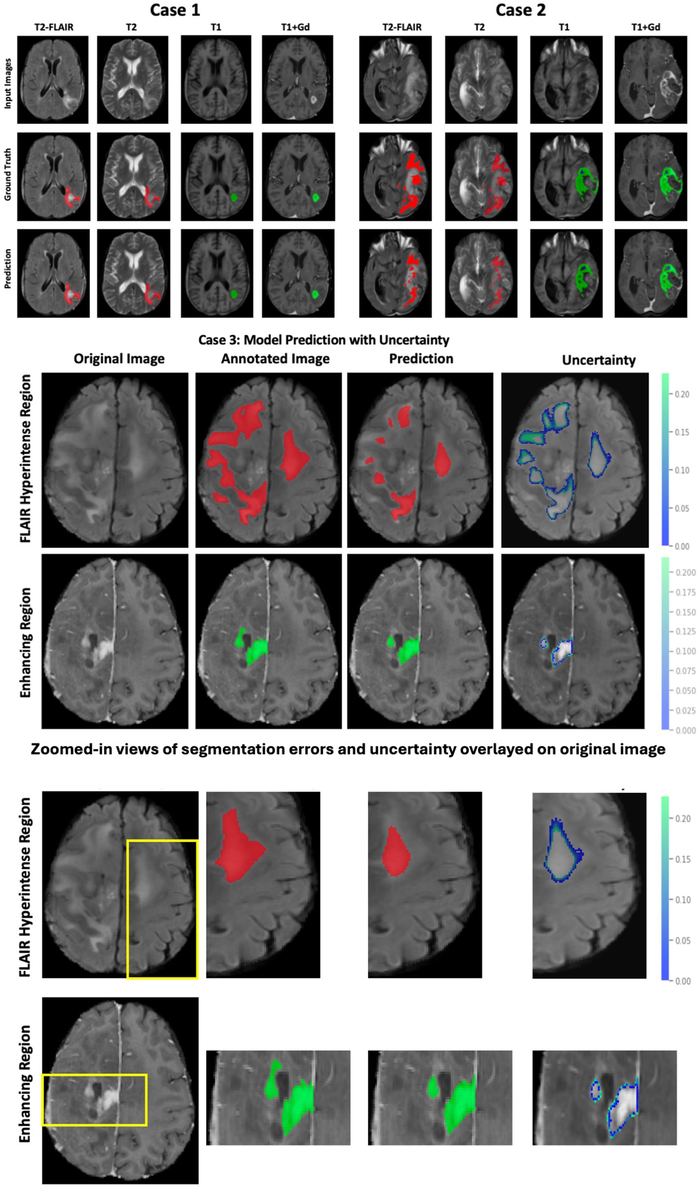 MRI images display segmentation comparisons for two cases. The input, ground truth, and prediction rows show T2-FLAIR, T2, T1, and T1+Gd scans. Case 3 highlights model prediction with uncertainty for FLAIR hyperintense and enhancing regions. Red and green areas indicate annotations and predictions, with blue outlines marking uncertainty. Zoomed views of segmentation errors are included.