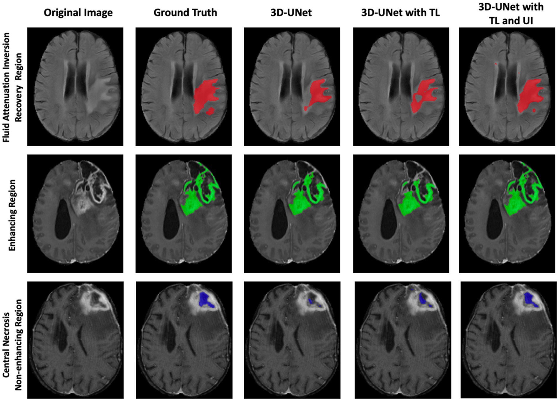 A grid of brain MRI images shows three lesion regions: Fluid Attenuation Inversion Recovery, Enhancing, and Central Necrosis Non-enhancing. Columns display the original image, ground truth with colored regions, and results from 3D-UNet models, including with TL, and TL and UI. Lesions are marked in red, green, and blue for the respective regions.