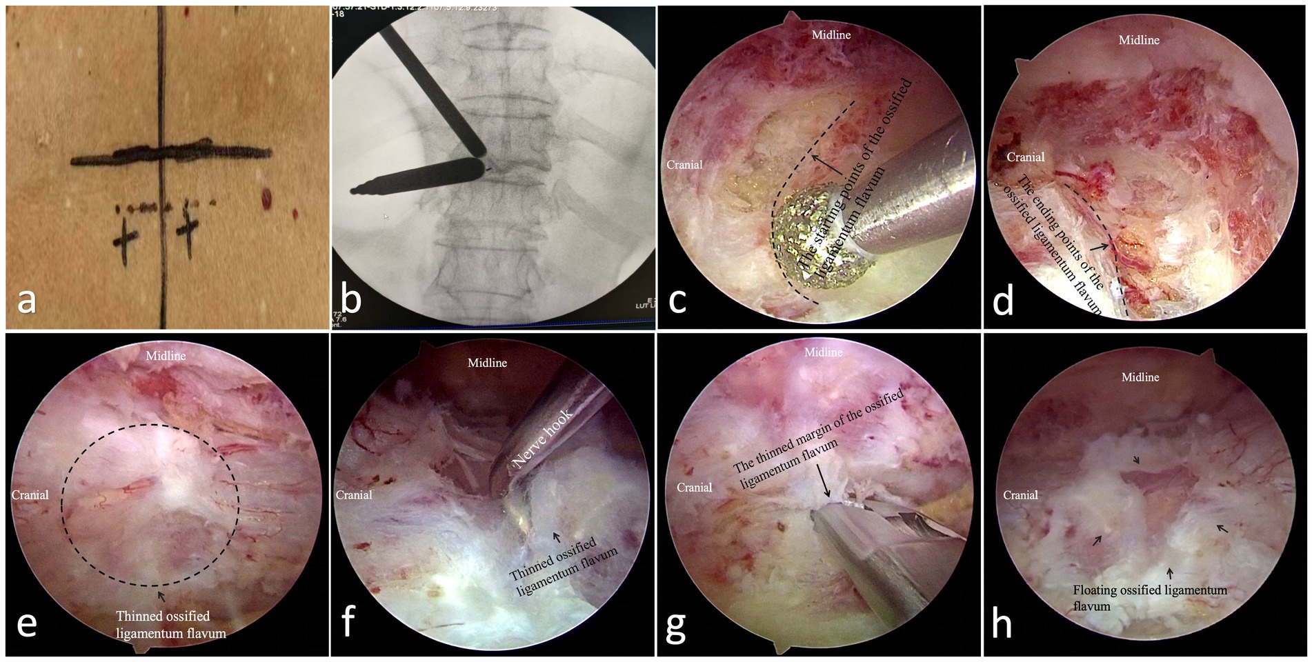 Surgical procedure series depicting steps in addressing an ossified ligamentum flavum. Image (a) shows incision markings on the skin. Image (b) is an X-ray of surgical instruments targeting the spine. Images (c-h) are endoscopic views: Image (c) shows the starting points of the ossified ligamentum flavum. Image (d) highlights the ending points. Image (e) displays a thinned area. Image (f) uses a nerve hook for detail. Image (g) demonstrates thinned margin removal. Image (h) reveals the floating ossified ligamentum flavum.
