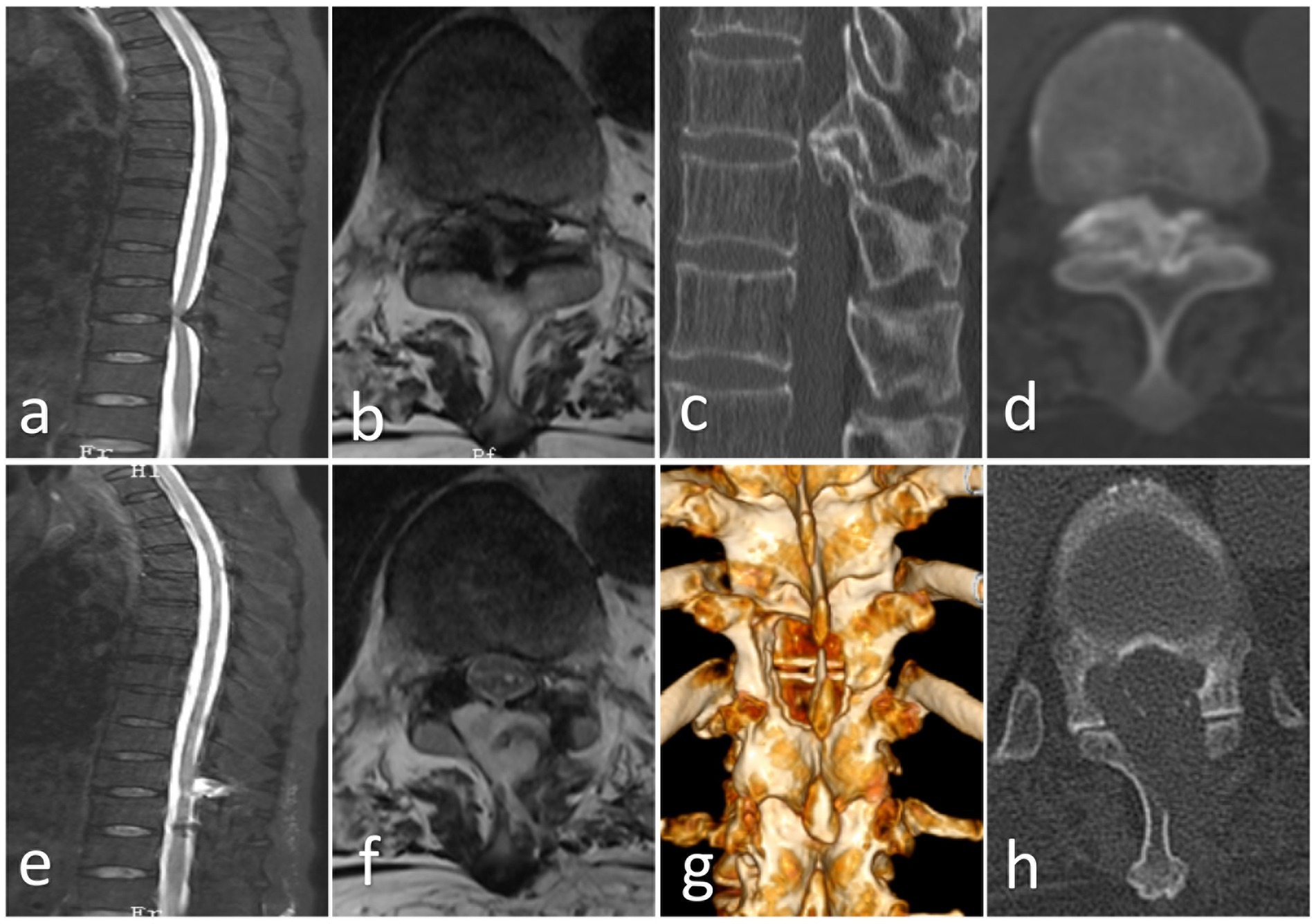 MRI and CT scan images of the lumbar spine. Images a and e show sagittal MRI views. Images b and f display axial MRI views. Images c and h show sagittal CT views. Image d is an axial CT view. Image g is a 3D reconstruction of the lumbar spine.