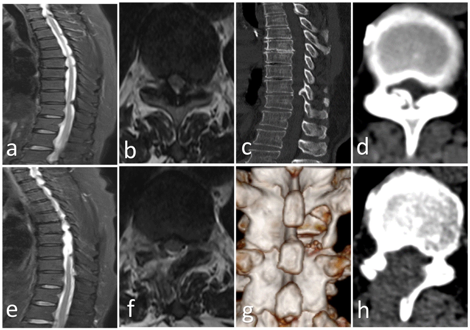 A series of medical images labeled a to h, showing two sets of spinal scans. Images a and e depict sagittal MRIs of the spine, images b and f show axial MRIs, images c and g display computed tomography scans including a 3D reconstruction, and images d and h are cross-sections.