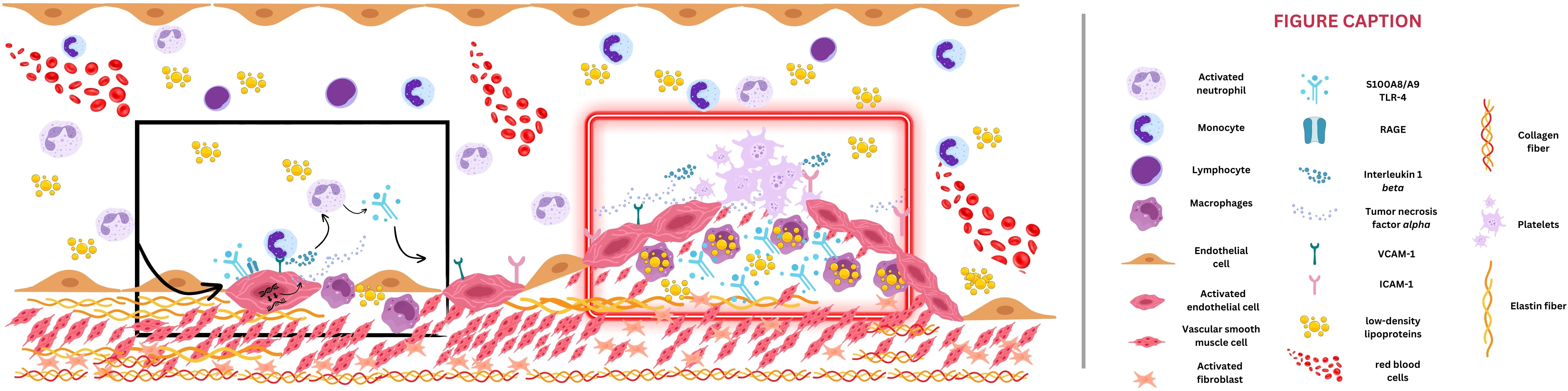 Illustration of a biological process showing various cells and proteins. Key elements include activated neutrophils, monocytes, lymphocytes, macrophages, endothelial cells, and fibroblasts, alongside collagen and elastin fibers, platelets, and red blood cells. The figure highlights interactions involving low-density lipoproteins, interleukin 1 beta, tumor necrosis factor alpha, and adhesion molecules VCAM-1 and ICAM-1. Accompanying legend provides detailed explanations of components and interactions.