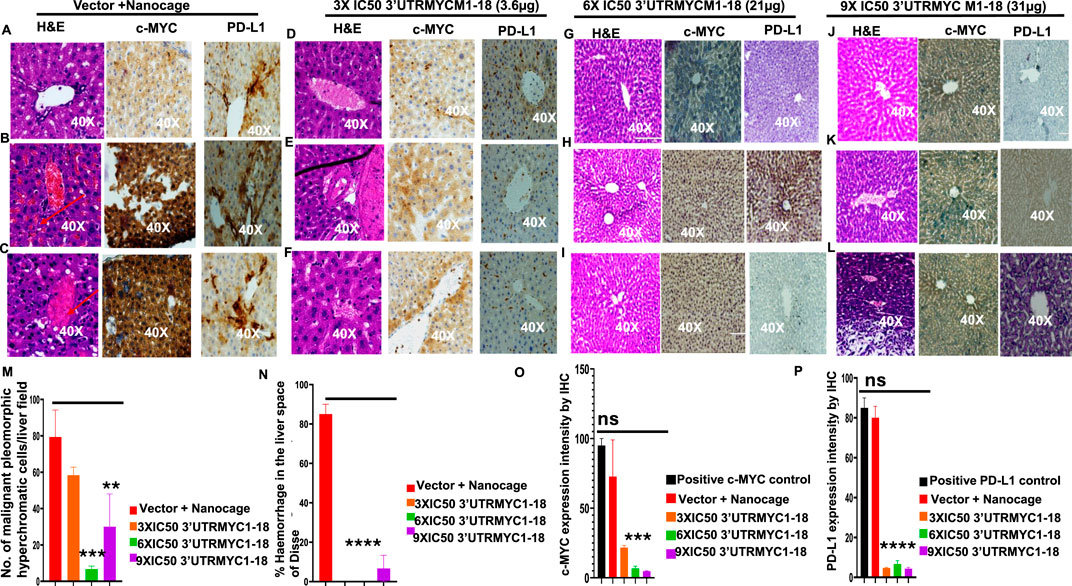 Microscopic images show liver tissue under different conditions: Vector+Nanocage, 3X IC50, 6X IC50, and 9X IC50 with H&E, c-MYC, and PD-L1 staining at 40X magnification. Bar graphs below display quantifications: number of malignant cells, hemorrhage percentage, c-MYC, and PD-L1 expression. Comparisons indicate differences in expression levels, with statistical significance marked by asterisks.