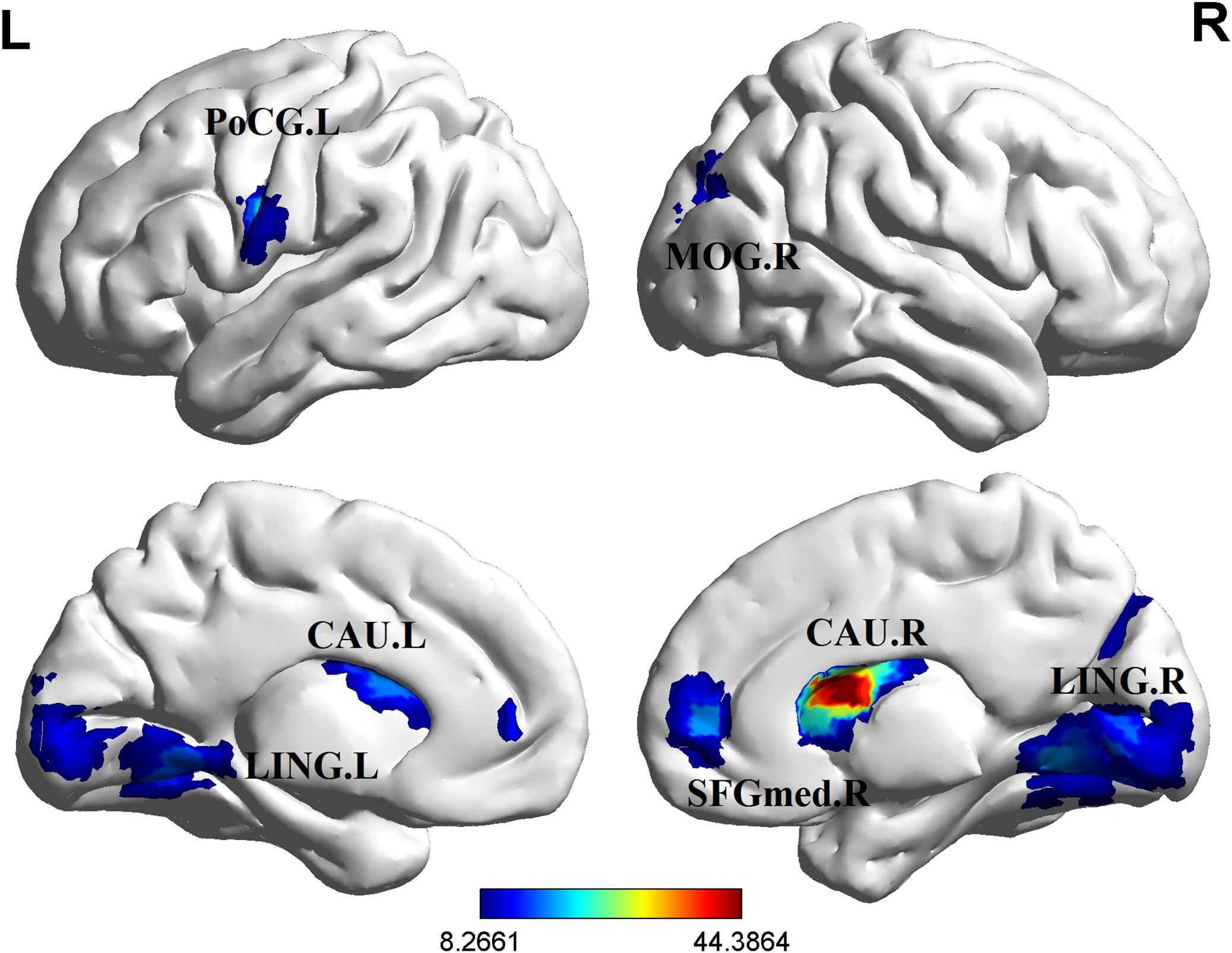 Brain images highlighting various regions with color-coded data overlays. Top left shows PoCG.L in blue, top right highlights MOG.R. Bottom left shows CAU.L and LING.L, while the bottom right features CAU.R, LING.R, and SFGmed.R. A color bar ranging from blue to red indicates data values between 8.2661 and 44.3864.