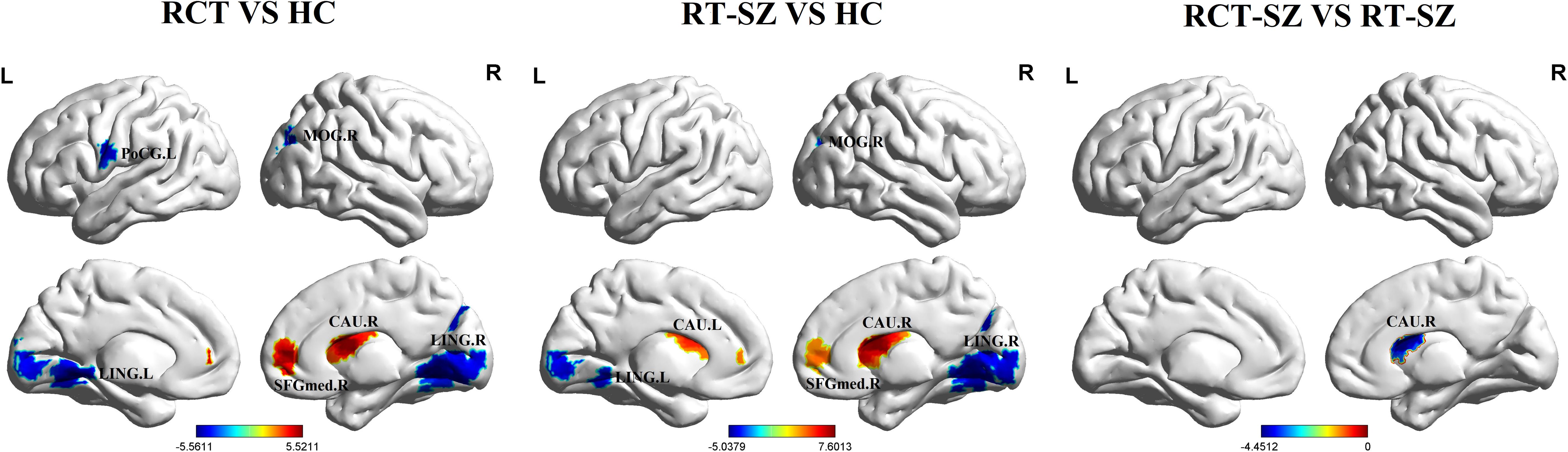 Brain imaging comparison showing three sets of brain models: RCT vs HC, RT-SZ vs HC, and RCT-SZ vs RT-SZ. Each set contains two models displaying lateral and medial views with colored regions. Blue and red gradients indicate changes, with labels like PoCG.L, LING.L, CAU.R, and SFGmed.R marking specific brain areas. A color bar indicates the scale from negative to positive values.