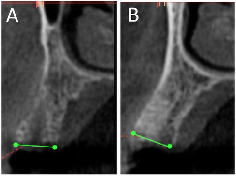Two side-by-side gray scale CT scan images labeled A and B. Each image shows a cross-section of bone structures with a green line and markers indicating measurements. The lines follow a similar path across a darker region, possibly indicating a consistent anatomical feature.