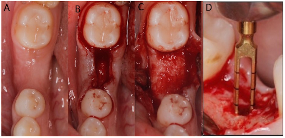 Images A to D depict a dental surgical procedure. A shows a row of healthy teeth. B and C reveal the gum incision around a tooth. D displays a tool used near the tooth for surgical purposes.