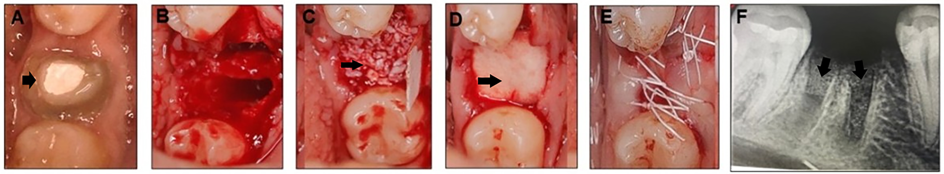 Panels A to E show stages of a dental surgical procedure involving teeth and gingiva. Panel A shows a non restorable tooth, B displays the site after tooth extraction, C shows gradt material application, D shows covering with a membrane, and E displays suture. Panel F is an x-ray highlighting the graft material in the socket.