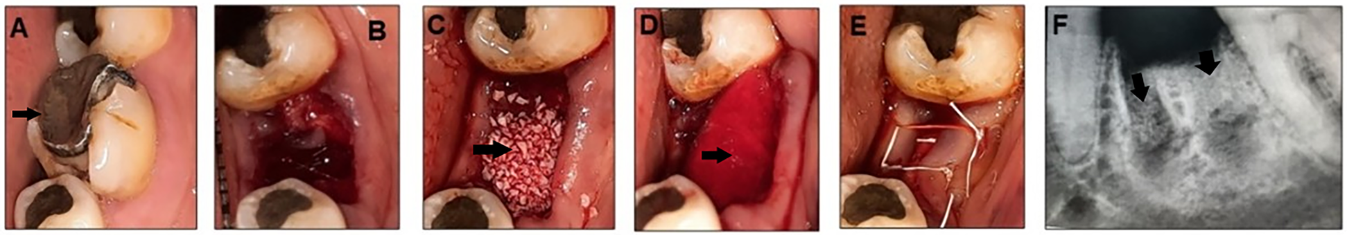 A series of six dental images illustrating a procedure. (A) Shows a decayed tooth with a visible cavity. (B) Displays the site after tooth extraction. (C) Shows bone graft material applied to the area. (D) Displays the graft smoothly covering the extraction site. (E) Shows sutures securing the graft in place. (F) An X-ray image highlights the graft placement within the jawbone.