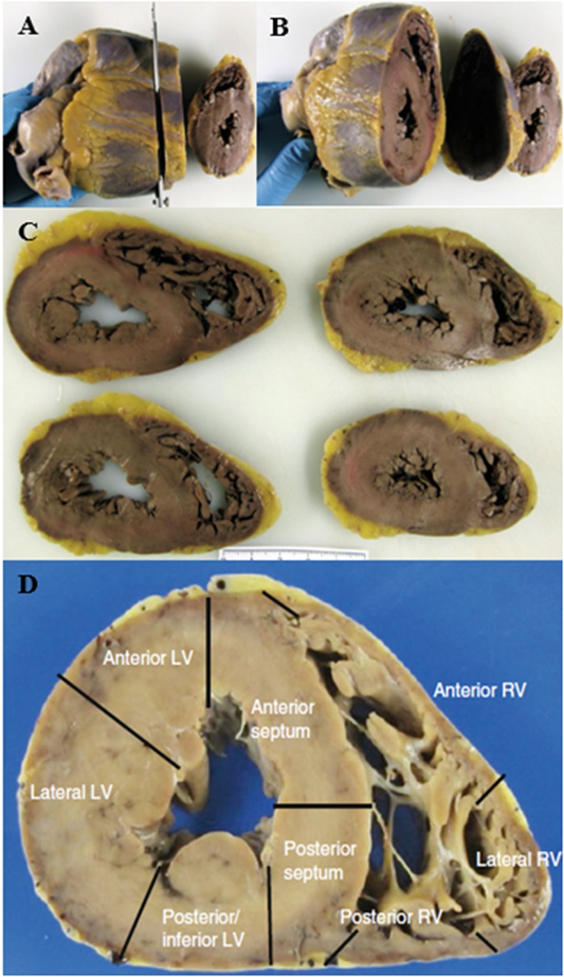 Four-panel image of heart cross-sections. Panel A shows a heart being sliced. Panel B displays the heart after slicing, with defined layers. Panel C features multiple cross-sections laid out. Panel D details a labeled cross-section highlighting regions such as anterior and lateral left ventricle (LV), anterior septum, posterior septum, and various parts of the right ventricle (RV).