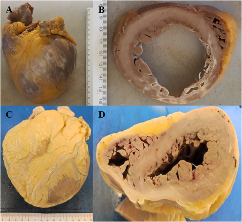 Four-panel image of dissected heart and aorta. Panel A shows a whole heart with a yellowish fatty covering. Panel B displays a cross-section of the aorta with ruler measurement. Panel C shows the heart’s anterior view with fatty tissue. Panel D exhibits a longitudinal heart section, revealing interior chambers and muscle tissue.