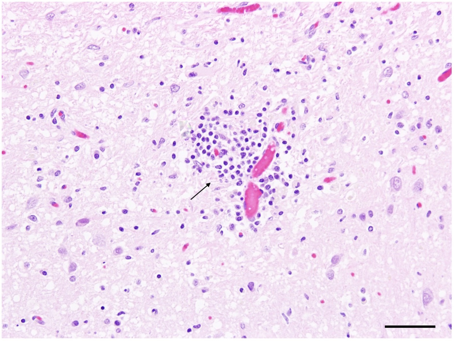 Microscopic image showing a cluster of small, round, purple-stained cells in a pale pink background, indicating inflammation. A black arrow points to the area of cell aggregation.