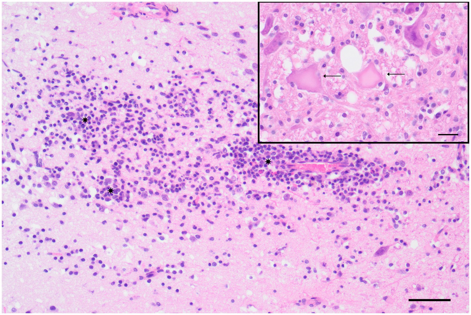 Microscopic image showing a section of brain tissue stained for analysis. The main area reveals clusters of small, densely packed cells marked with asterisks. An inset displays a magnified view, identifying two elongated neuronal cells indicating cell death marked with arrows.
