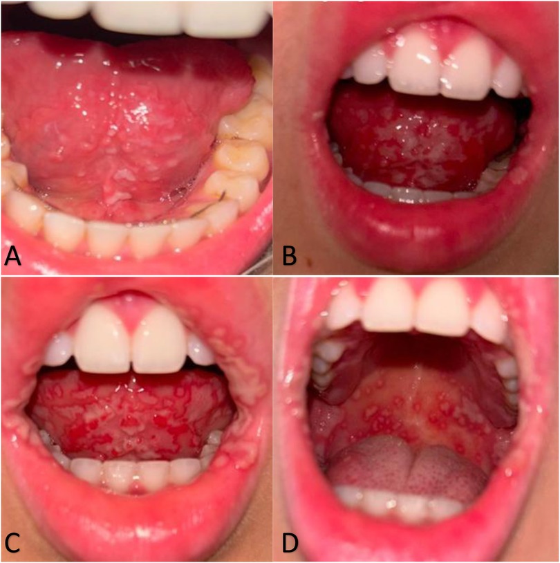 Four panels showing close-up views of mouths with various oral conditions. Panel A shows a tongue with lesions. Panel B displays a mouth with inflamed gums and a textured tongue. Panel C highlights white patches and inflammation inside the mouth. Panel D presents red spots visible on the palate and a speckled tongue.