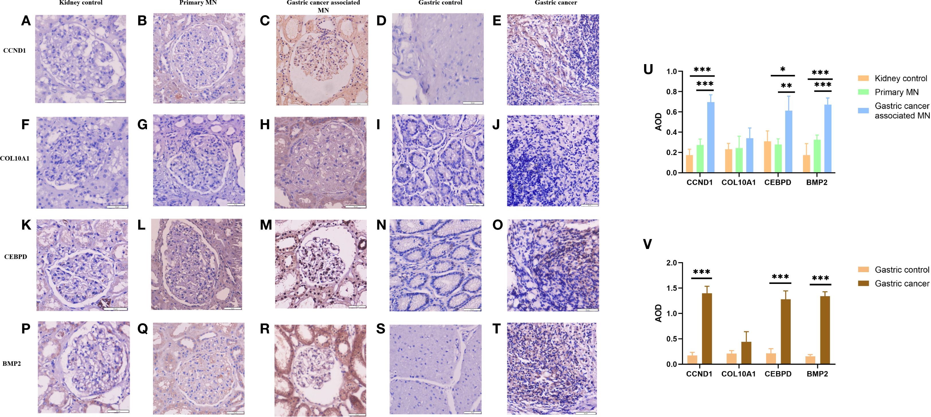 Composite image with immunohistochemical micrographs and quantitative bar charts. Panels A–T show staining of CCND1, COL10A1, CEBPD, and BMP2 in renal tissues (normal control, primary membranous nephropathy, gastric cancer–associated MN) and gastric tissues (normal and gastric cancer). Panels U and V present bar charts of average optical density (AOD) values for each protein across groups, illustrating differences in expression. Asterisks indicate statistical significance (*p < 0.05, **p < 0.01, *p < 0.001), highlighting distinct expression patterns between disease and control samples.