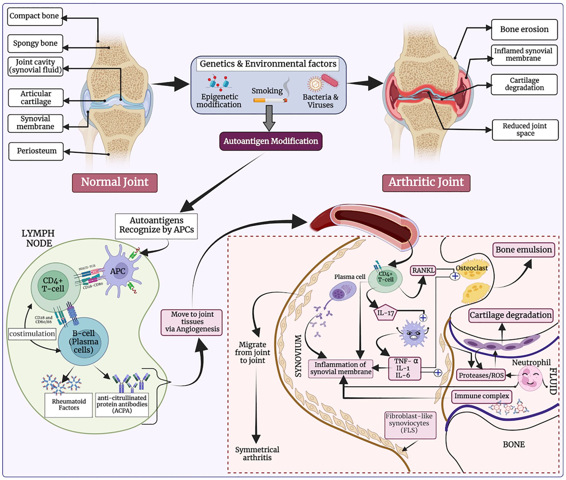Diagram showing the progression from a normal joint to an arthritic joint, highlighting bone erosion, inflamed synovial membrane, and cartilage degradation. It illustrates how genetic and environmental factors, including smoking and infections, lead to autoantigen modification. The autoimmune response involves CD4+ T-cells, B-cells, and the production of rheumatoid factors. Autoantigens are recognized by antigen-presenting cells, leading to inflammation, synovial membrane degradation, and joint deterioration. The process includes cytokines like IL-17 and TNF-alpha, osteoclast activation through RANKL, and the role of fibroblast-like synoviocytes.