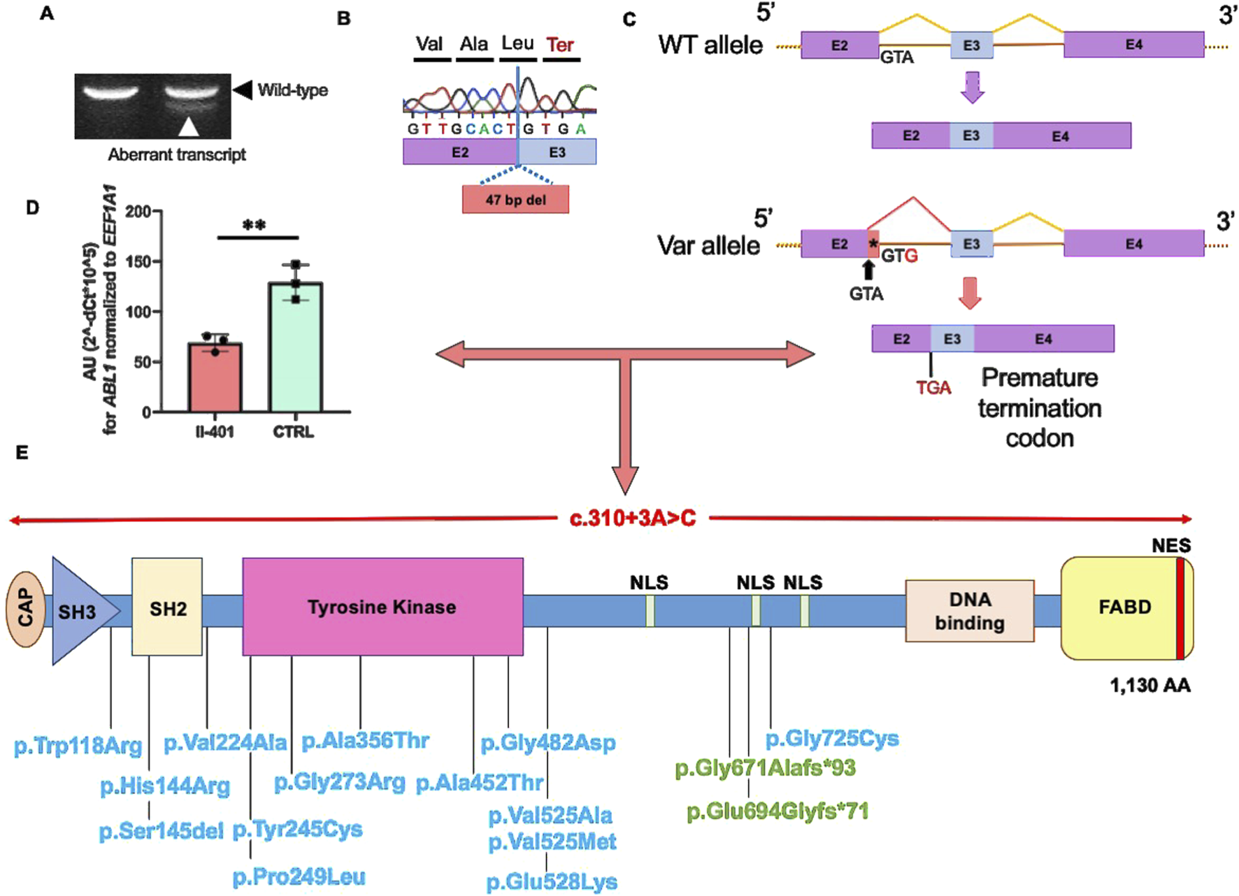 Diagram illustrating genetic alterations and their effects. Panels A to D show PCR results, nucleotide sequences, and bar graphs comparing wild-type and variant alleles, detailing an aberrant 47 base pair deletion leading to a premature stop codon. Panel E displays a schematic of a protein domain structure, highlighting the locations of various mutations such as p.Trp118Arg and p.Gly482Asp. NLS, NES, and tyrosine kinase domains are shown, with a mutation site c.310+3A>C mapped to the protein's sequence, resulting in multiple amino acid substitutions.