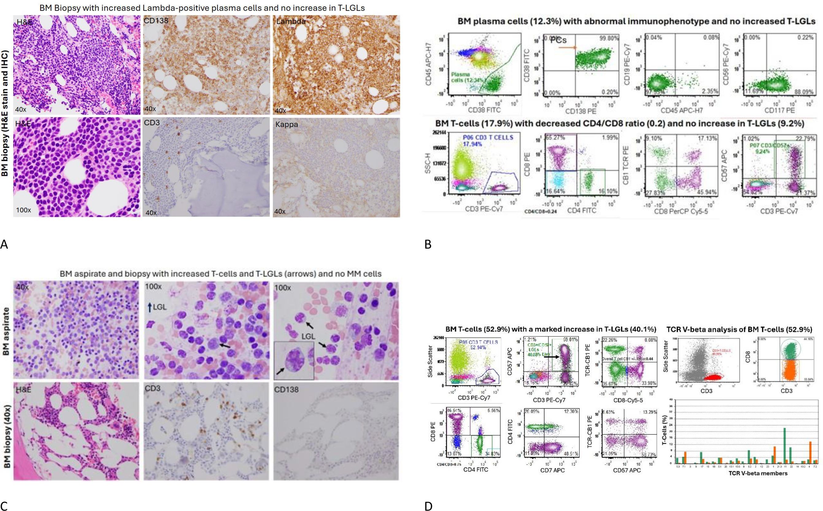 Panel A shows bone marrow biopsy images with increased lambda-positive plasma cells and no T-LGL increase, including various stains (H&E, CD138, Lambda, CD3, Kappa) at different magnifications. Panel B presents flow cytometry data of abnormal plasma cells and decreased CD4/CD8 ratio T-cells, lacking T-LGL increase. Panel C displays bone marrow aspirate and biopsy images indicating increased T-cells and T-LGLs with arrows, showing stains (H&E, CD3, CD138) at different magnifications, with no multiple myeloma cells. Panel D contains flow cytometry data showing increased T-LGLs in bone marrow T-cells, alongside TCR V-beta analysis.