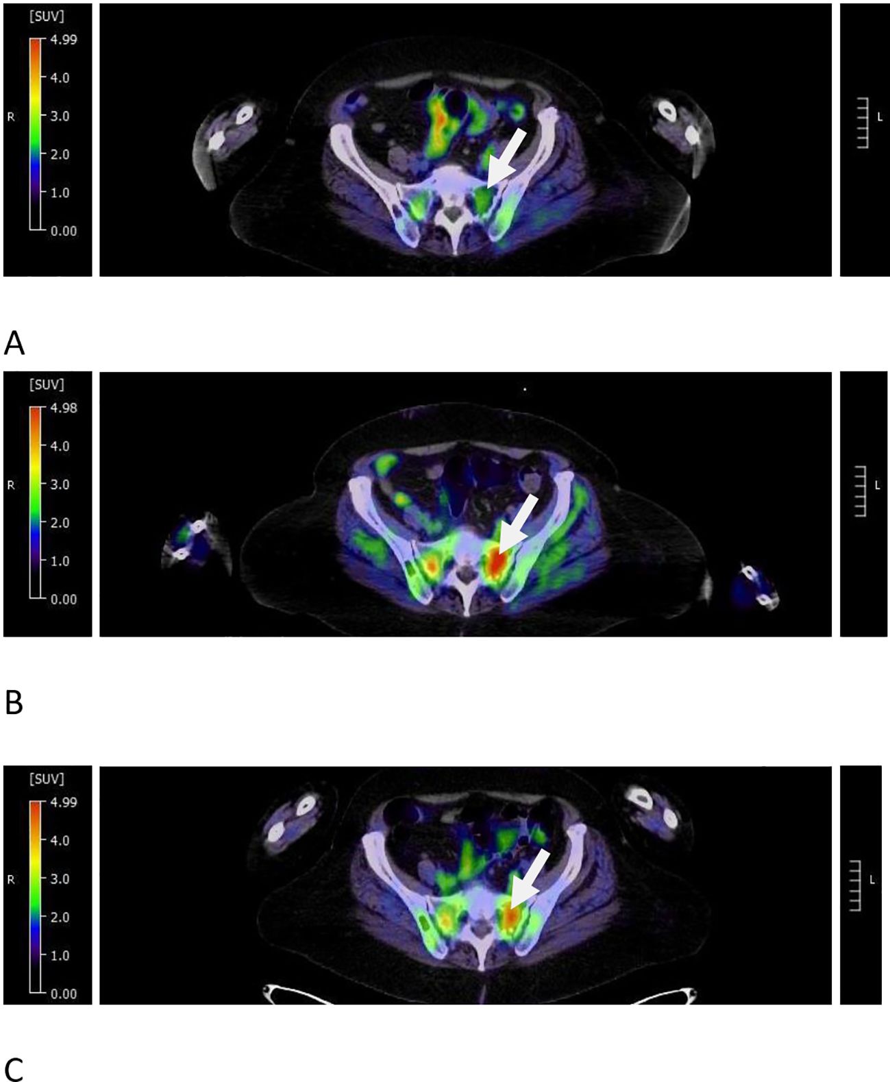 Three MRI scans labeled A, B, and C display cross-sectional views of the pelvic region. Each scan shows varying levels of signal intensity, marked by color gradients indicating standardized uptake values (SUV) from 0.00 to 4.99. White arrows point to areas of high signal intensity.