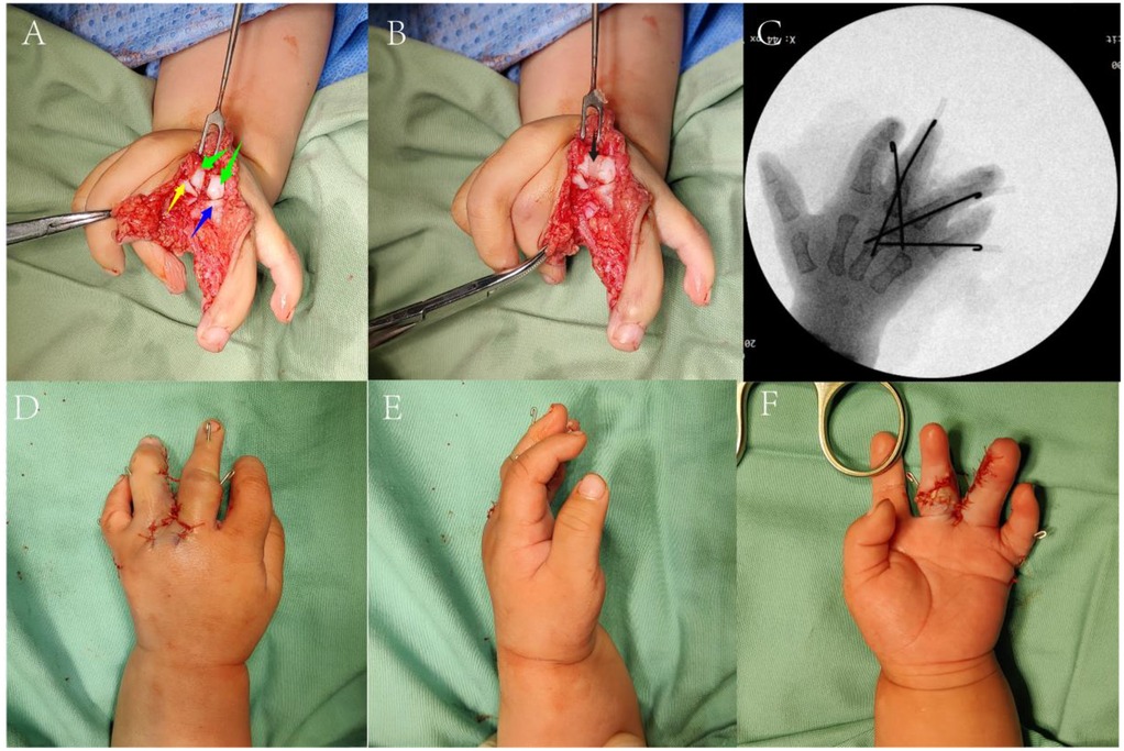 Series of images depicting surgical procedures on a child's hand. Image A and B show an open hand surgery with visible bones and marked points. Image C is an X-ray showing pins in the hand. Images D, E, and F display the hand post-surgery with stitches and pins, showing stages of recovery.