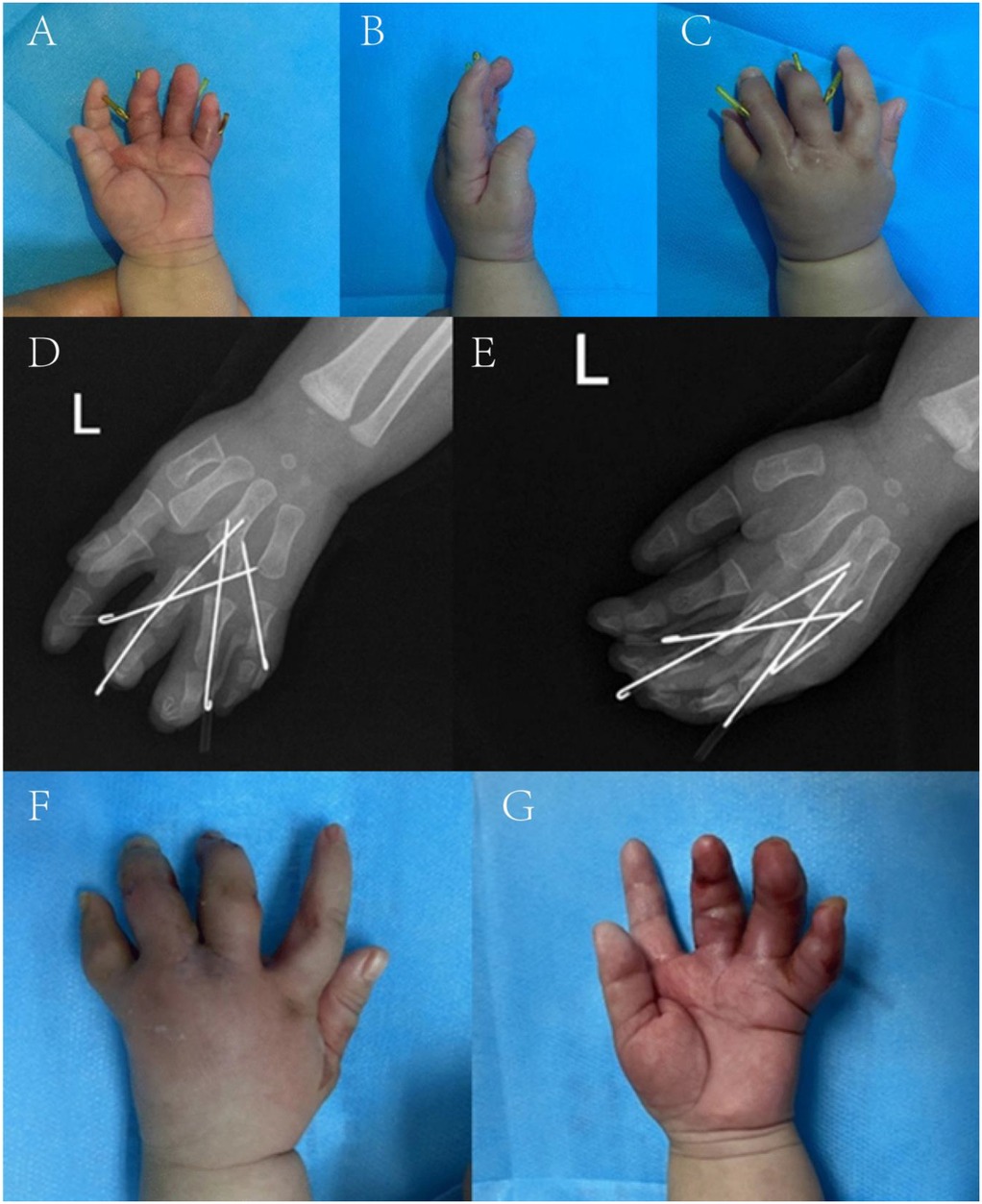 A series of images showing a child's hand with surgical pins and post-operative X-rays. Images A, B, and C display the hand from different angles with external fixation using pins. Images D and E are X-ray views of the hand, highlighting internal fixtures. Images F and G show the healing hand without pins, with visible scarring. The background is a blue medical drape.