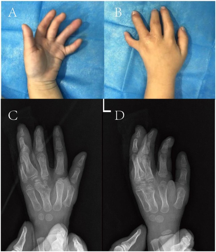Four-panel image showing two photographs and two X-rays of a child's hand. Panel A displays the palm view, and Panel B shows the back of the hand. Panels C and D are X-rays, corresponding to the views in A and B, respectively, highlighting the bone structure. A blue background is visible in the photographs.