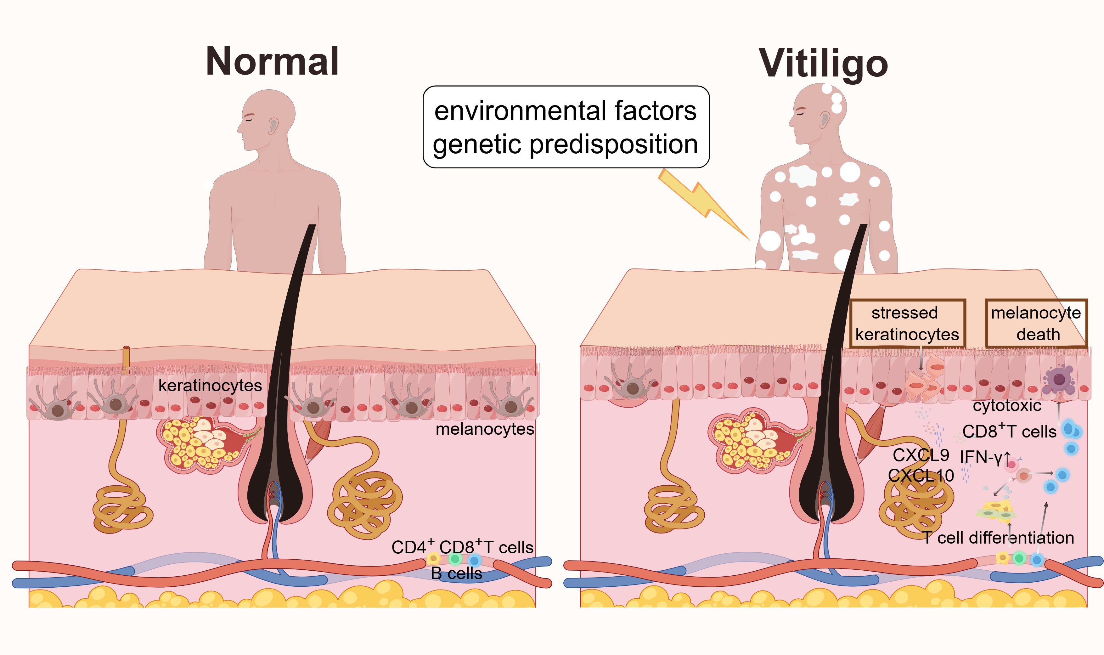 Comparison illustration of normal skin versus vitiligo-affected skin. The normal skin side shows a healthy epidermis with keratinocytes and melanocytes. The vitiligo side shows stressed keratinocytes, melanocyte death, and the presence of CD8+ T cells, indicating immune activity. Environmental factors and genetic predisposition contribute to vitiligo, depicted by lightning.