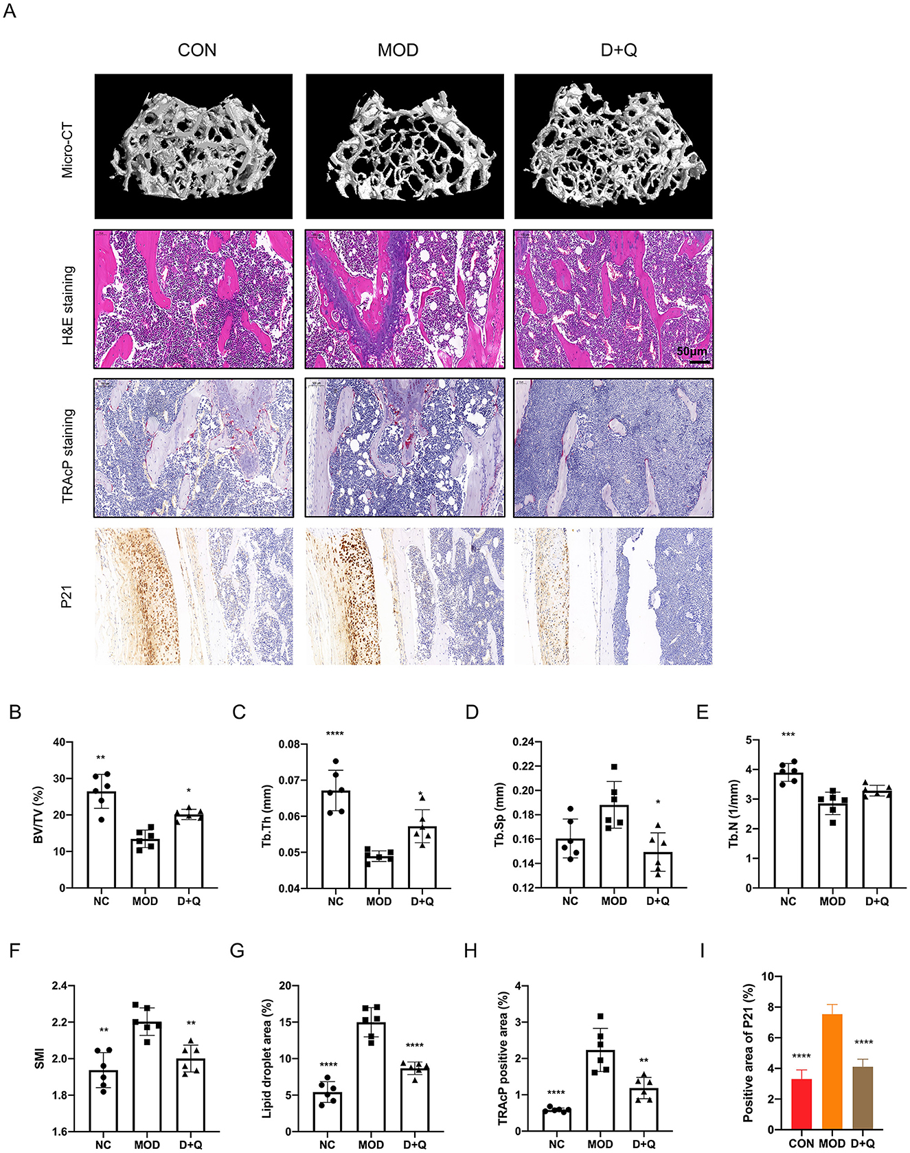Panel A shows a comparison of bone structure and staining results in three groups: CON, MOD, and D+Q. The first row displays micro-CT scans of bone, revealing structural differences. The second row shows H&E staining with variations in tissue appearance. The third row presents TRAP staining, highlighting osteoclast activity. The fourth row shows P21 staining, indicating cellular activity. Panels B to I display bar graphs comparing various metrics: bone volume to total volume, trabecular thickness, trabecular separation, trabecular number, structure model index, lipid droplet area, TRAP positive area, and P21 positive area among the three groups. Statistical significance is indicated.