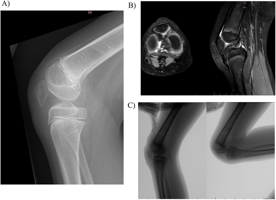 A three-part medical image showing knee assessments. A) X-ray of a lateral knee view. B) MRI images, with a transverse slice on the left and a sagittal slice on the right. C) Two X-ray images of the knee in different flexed positions.