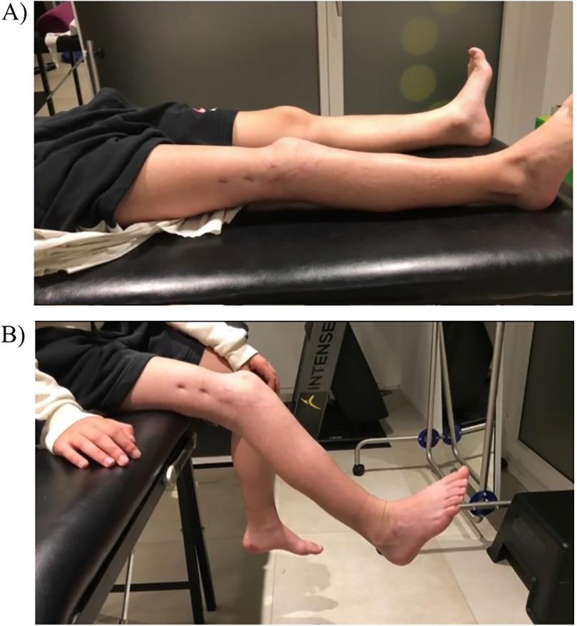 Panel A shows a person's legs extended on a medical examination table, with visible scars on the thigh. Panel B depicts the same person's legs, one bent and the other extended, showing scars on the thigh.