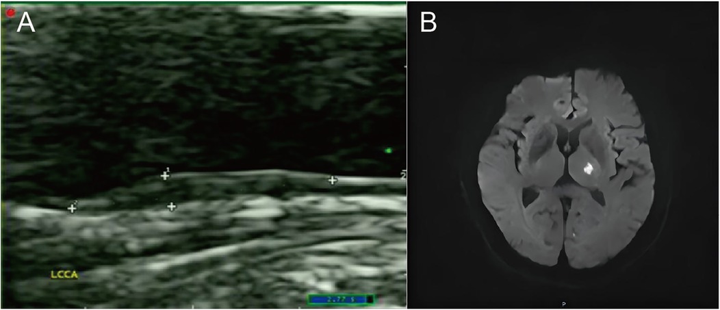 A panel of two medical images. On the left, labeled \