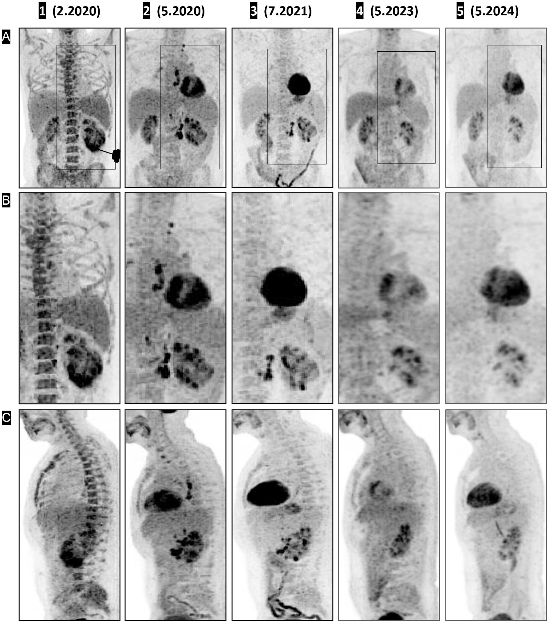Medical imaging comparison in three rows over five time points from February 2020 to May 2024. Row A shows coronal views, highlighting spinal and abdominal areas. Row B provides close-ups, focusing on lesion areas. Row C presents sagittal views of the spine throughout the timeline. Notable changes in density and lesion size are visible across the images.