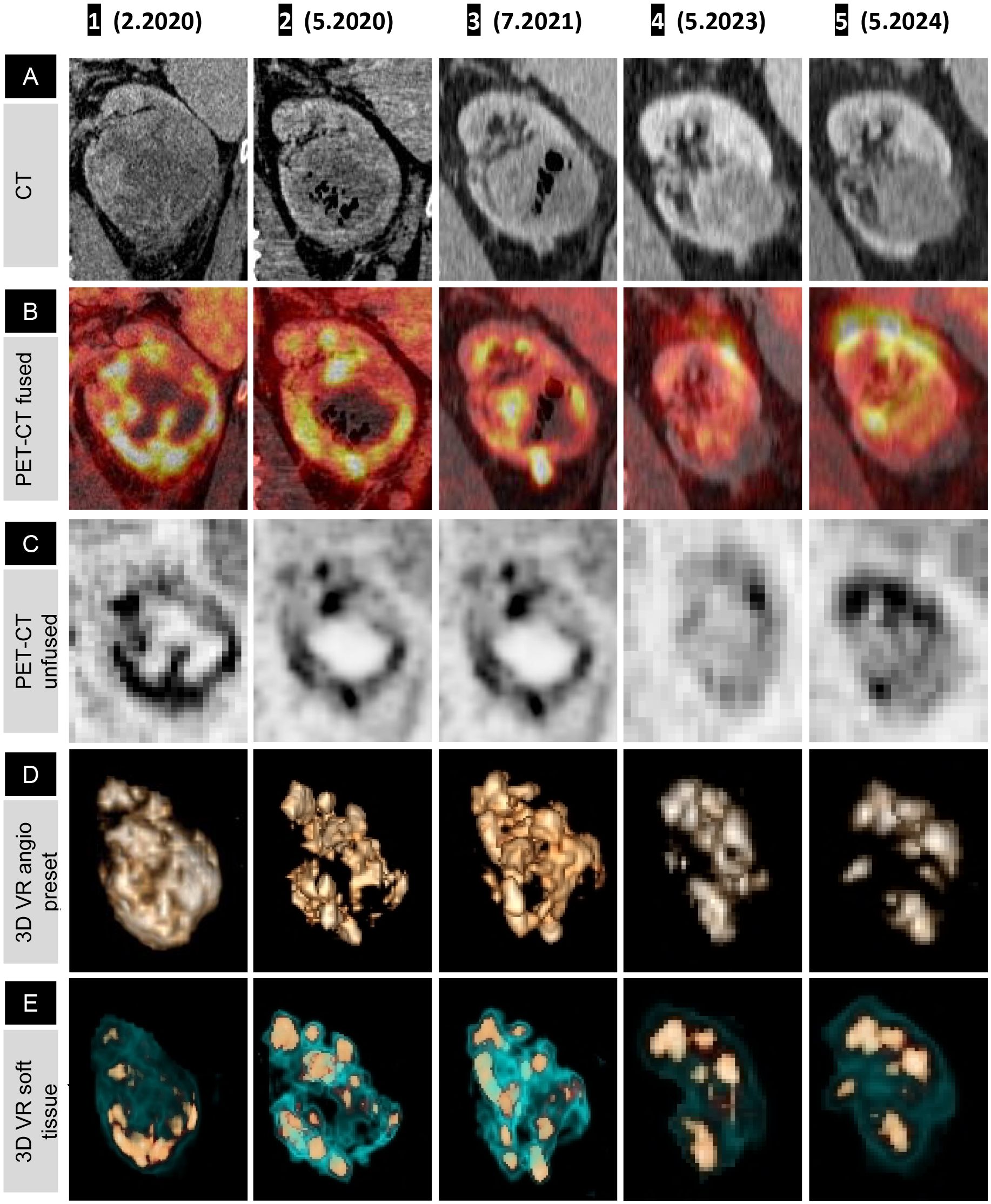 Five columns of medical imaging over time from February 2020 to May 2024. Row A shows CT scans. Row B presents fused PET-CT images with color mapping. Row C displays unfused PET-CT in grayscale. Row D shows 3D images with “VR angio preset.” Row E depicts 3D images with “VR soft tissue preset” in blue and green. Each row demonstrates visual changes across these dates, indicating progression or variation of an examined condition.