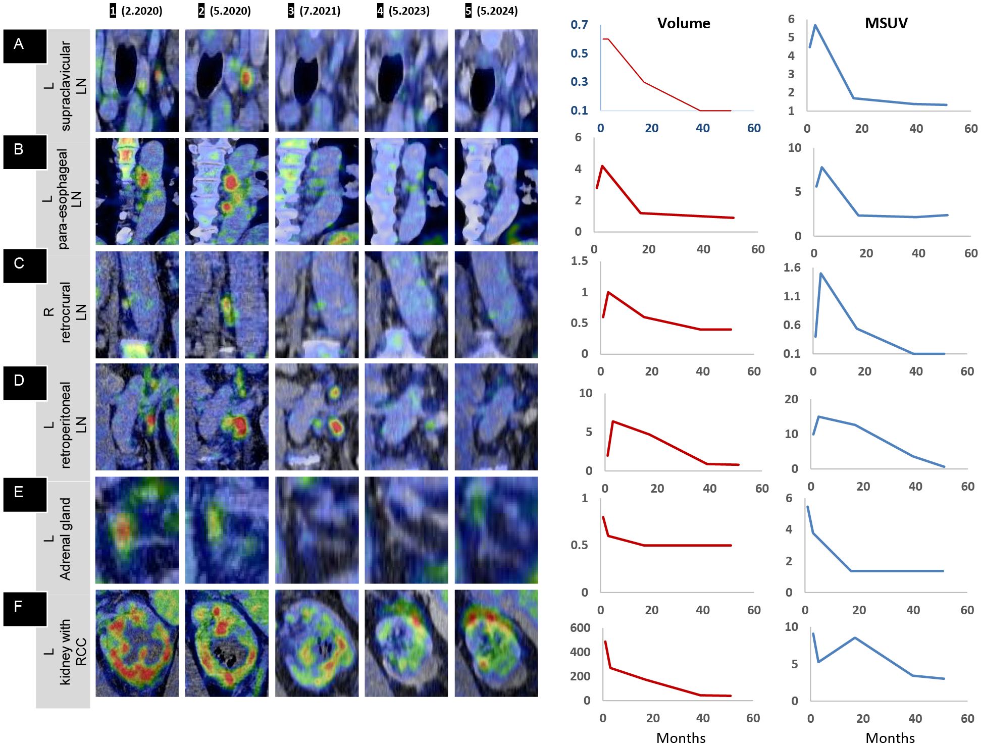 Medical imaging displaying PET/CT scans over time, from February 2020 to May 2024, labeled A to F, depicting various lymph node and organ areas. Adjacent graphs chart volume and MSUV changes, showing an overall downward trend.