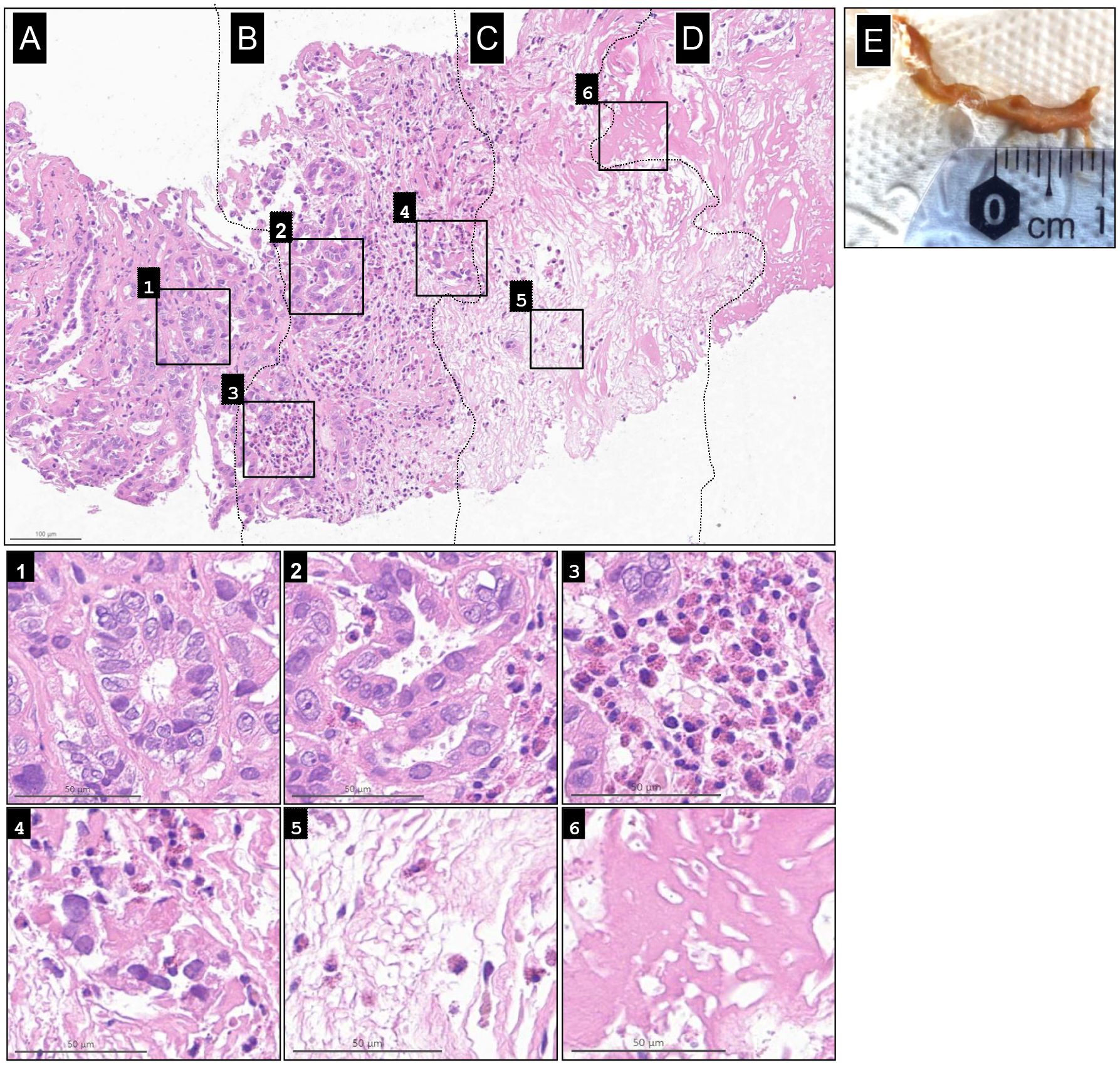 Histological sections labeled A through D show varying degrees of tissue morphology, with several areas highlighted for closer examination. Insets labeled 1 to 3 beneath the main image provide an enlarged view of specific cellular details, showing different cellular structures and staining intensities. The image in the top right corner, labeled F, shows a biological sample on a textured surface. The overall focus appears to be on examining tissue variations and cellular characteristics.